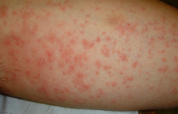 Trombicul&oacute;zu způsobuj&iacute; larvy sametek (http://www.lucianoschiazza.it)